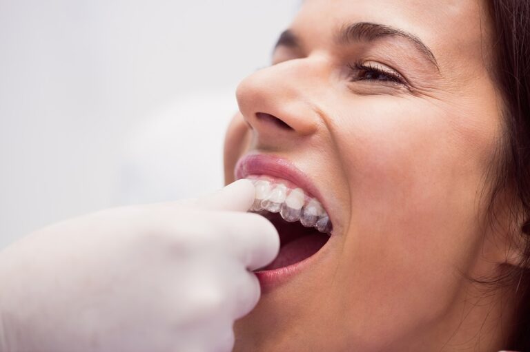 carillas-y-fundas-dentales