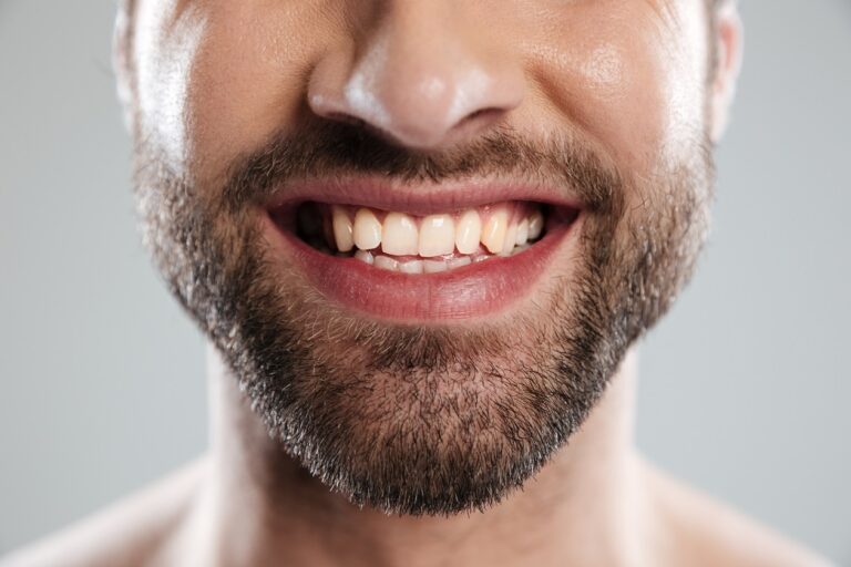 dientes-torcidos-clinica-dental