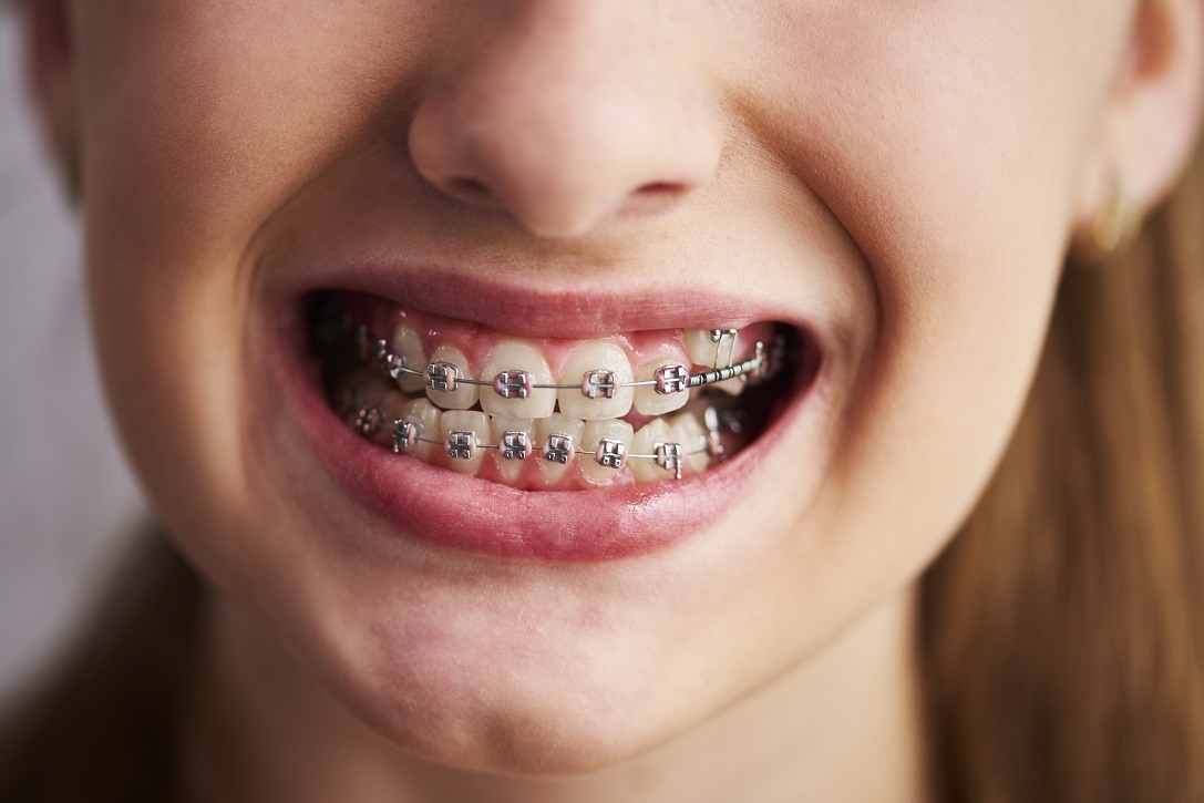 Cuánto tiempo tengo que llevar brackets? - DentSalut