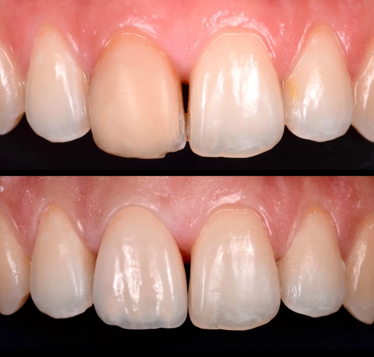 Antes y después de una carilla cerámica en un incisivo oscurecido en DentSalut Barcelona