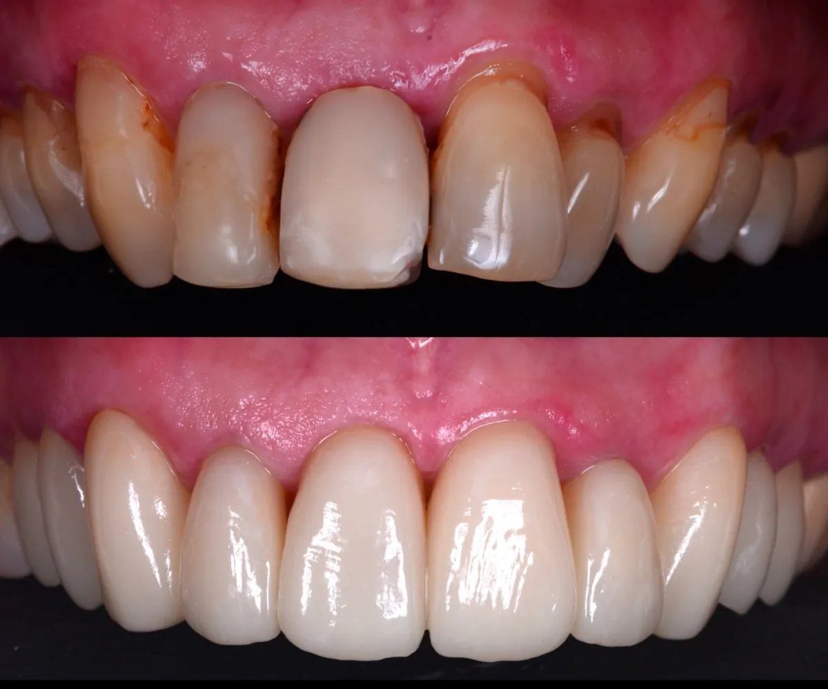 Antes y después de carillas de porcelana en dientes anteriores desalineados y con restauraciones antiguas