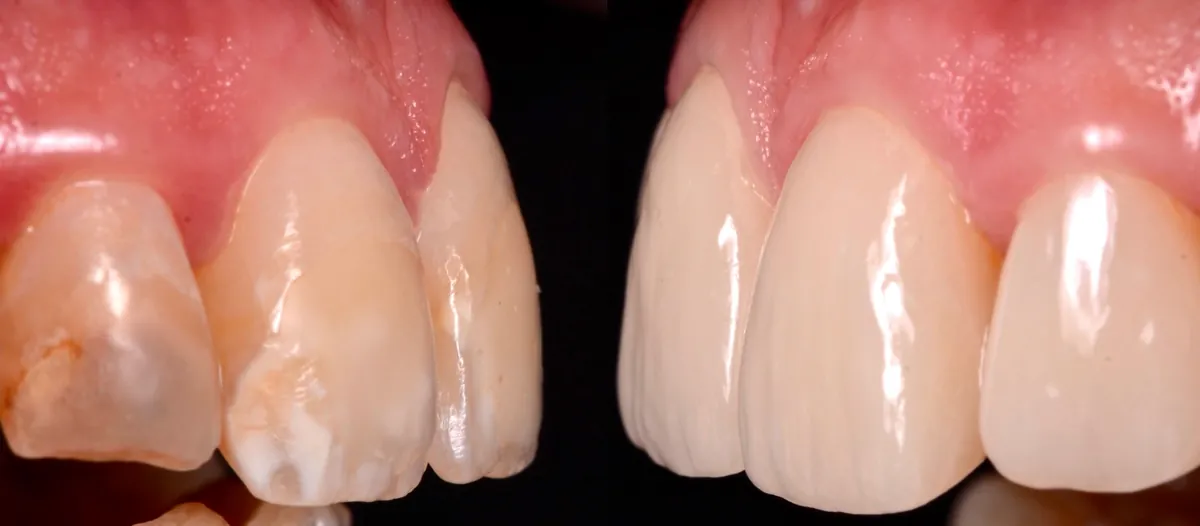 Antes y después de carillas cerámicas en dientes con manchas en el esmalte, vista lateral