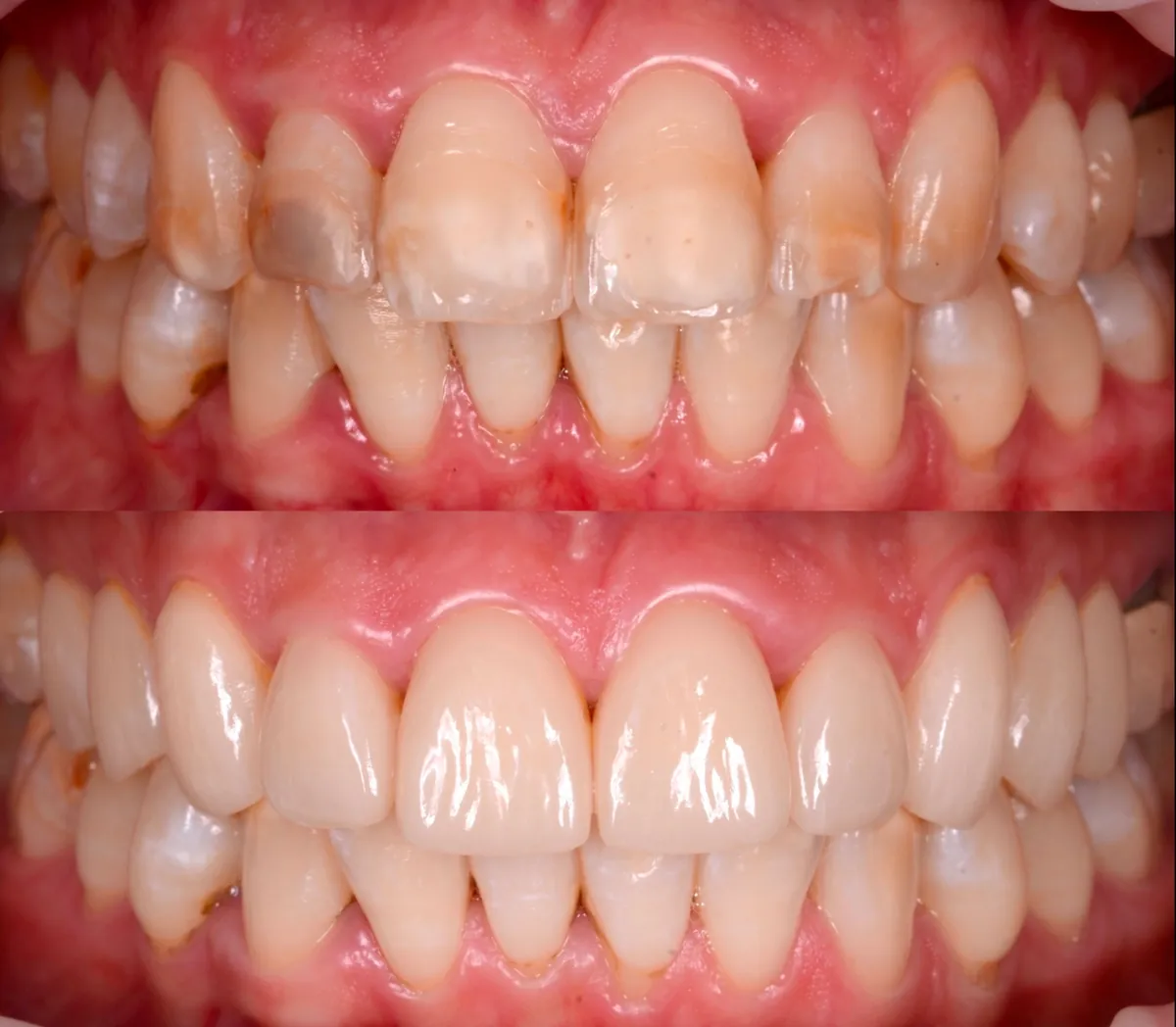 Antes y después de carillas cerámicas en Barcelona: dientes anteriores con manchas y desgaste transformados en una sonrisa uniforme