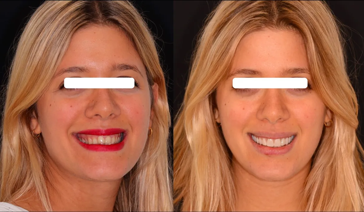 Sonrisa de una paciente antes y después de carillas de porcelana en Barcelona