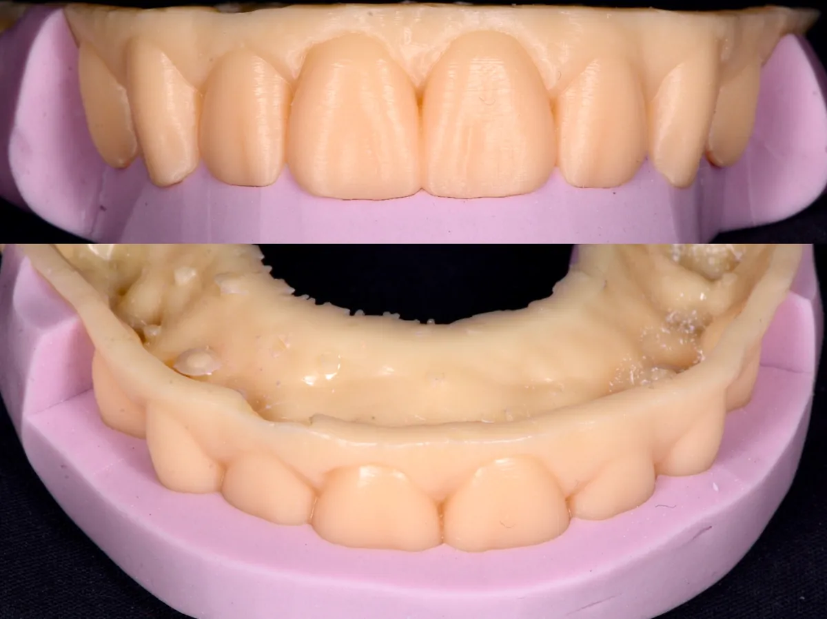Encerado diagnóstico para el diseño de carillas cerámicas en DentSalut