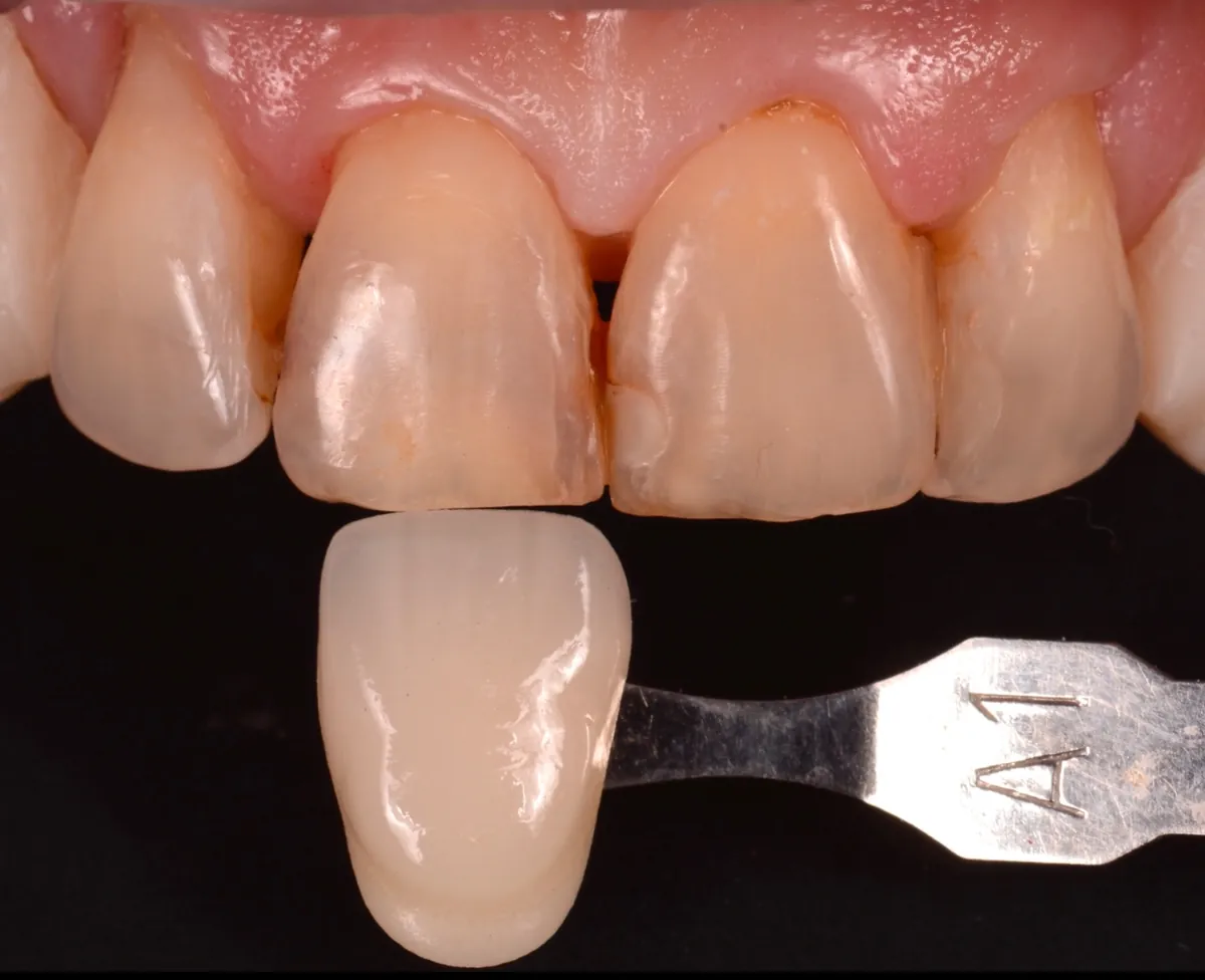 Selección del color de las carillas de porcelana con guía de colores dental