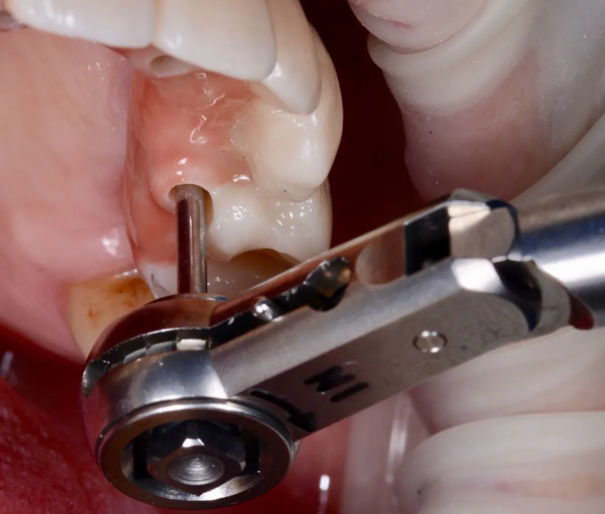 Colocación de una corona sobre implante con llave dinamométrica en DentSalut