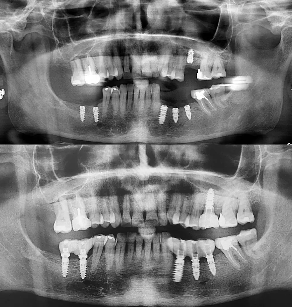 Radiografía panorámica antes y después de la rehabilitación con implantes dentales en Barcelona