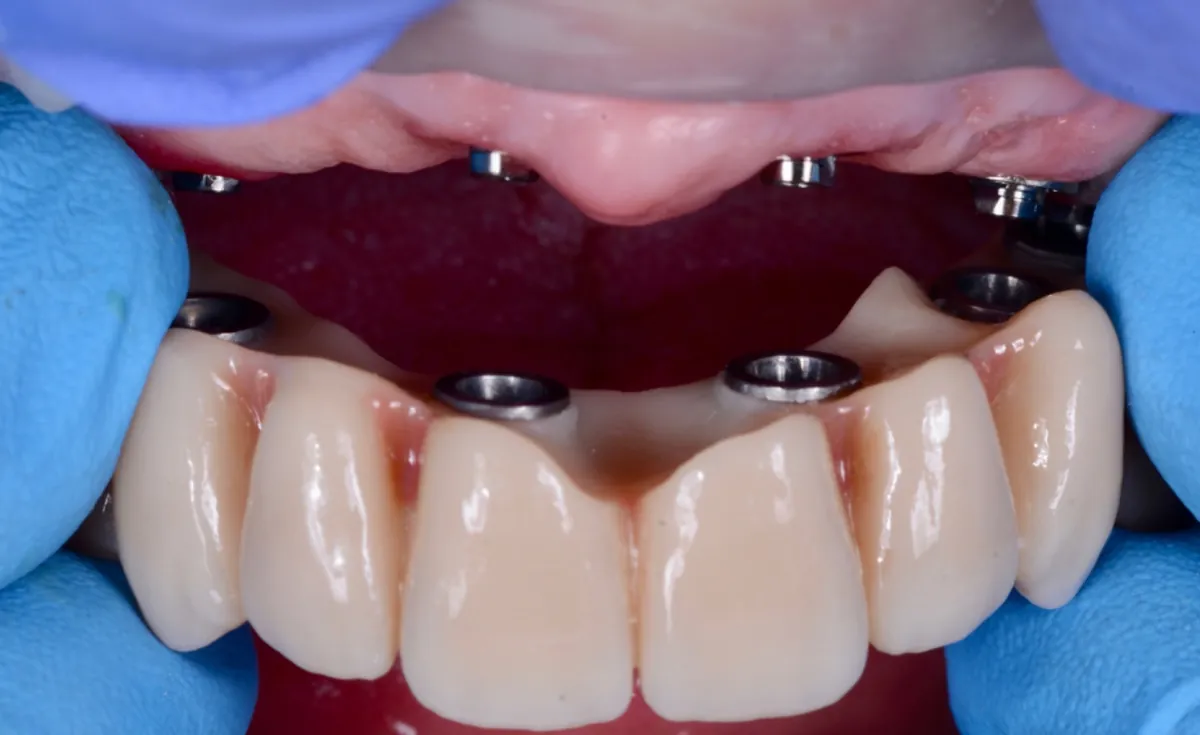 Prótesis fija de arcada completa sobre implantes preparada para su colocación