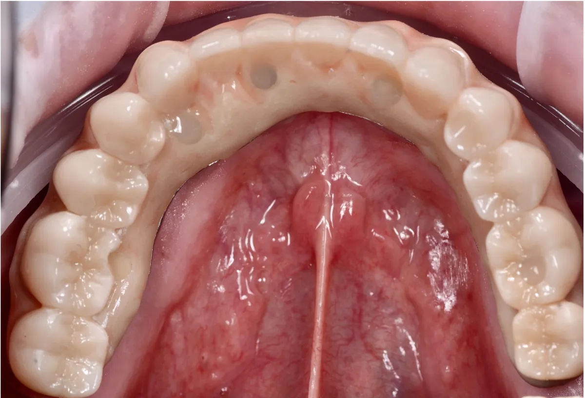 Resultado final de una prótesis fija sobre implantes en la arcada inferior