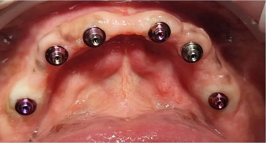 Arcada superior con 6 implantes dentales colocados para una prótesis fija